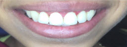 Gummy Smile correction with Laser Gum Lift - After