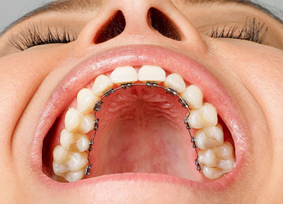 Lingual Orthodontics