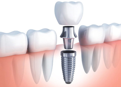 Implant Dentistry