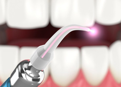 Laser Dentistry