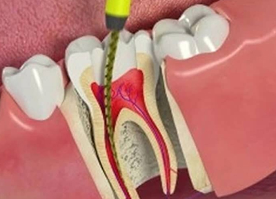 root-canal