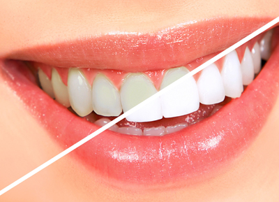 teeth-whitening